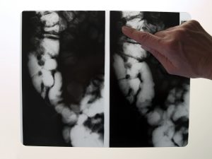 2 xrays of a colon side by side with a finger pointing at the xray on the right