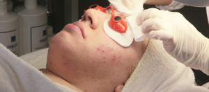 White female receiving acne facial