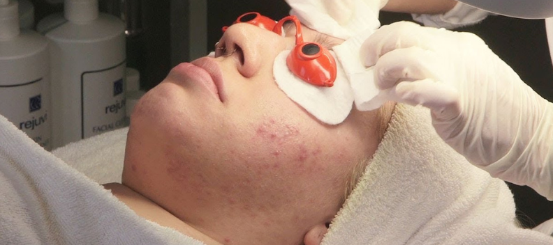 White female receiving acne facial 