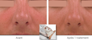 white male before and after algomask procedure