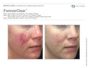 Before and After photo featuring the face of a white female before and after BBL Forever clear laser treatment