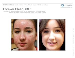 Before and After photo featuring the face of a white female with brown hair before and after BBL Forever clear laser treatment