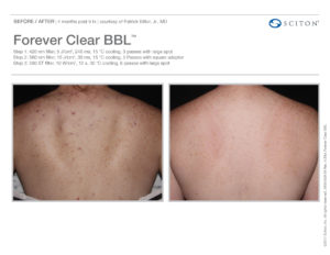 Before and After photo featuring the back of a white female before and after BBL Forever clear laser treatment