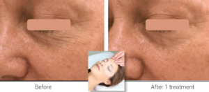 Before and after collagen sublime eye contour white male