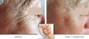 white female before and after bontinol treatment