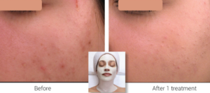 Before and after oxygenating facial on white female