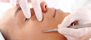 white female receiving dermplaning facial