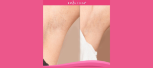 epilfree before and after featuring the neck of a white female