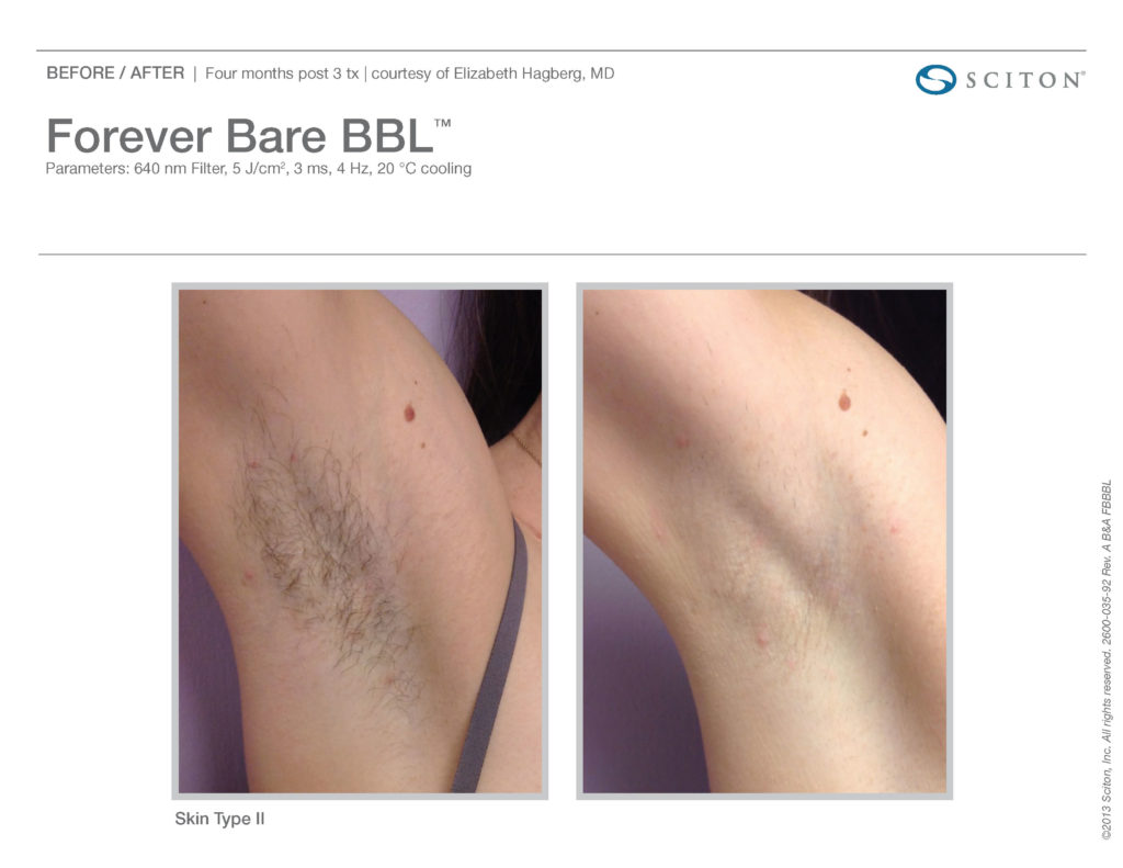 Forever BARE Laser treatment results of white female armpit before and after