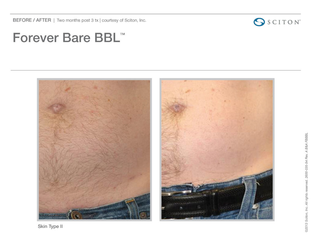 Forever BARE Laser treatment results of white male stomach before and after