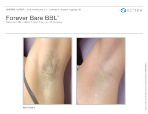 Forever BARE Laser treatment results of white female armpit before and after
