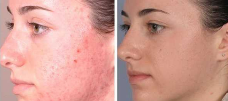 Microdermabrasion before and after with white female