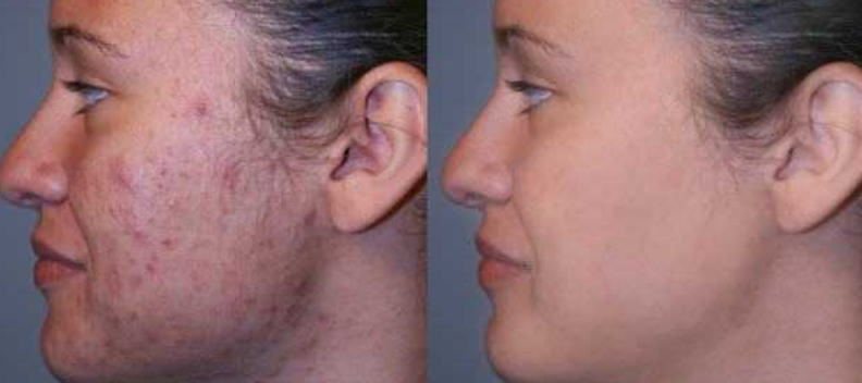 White female microfacial before and after