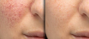 before and after of microneedling on white female