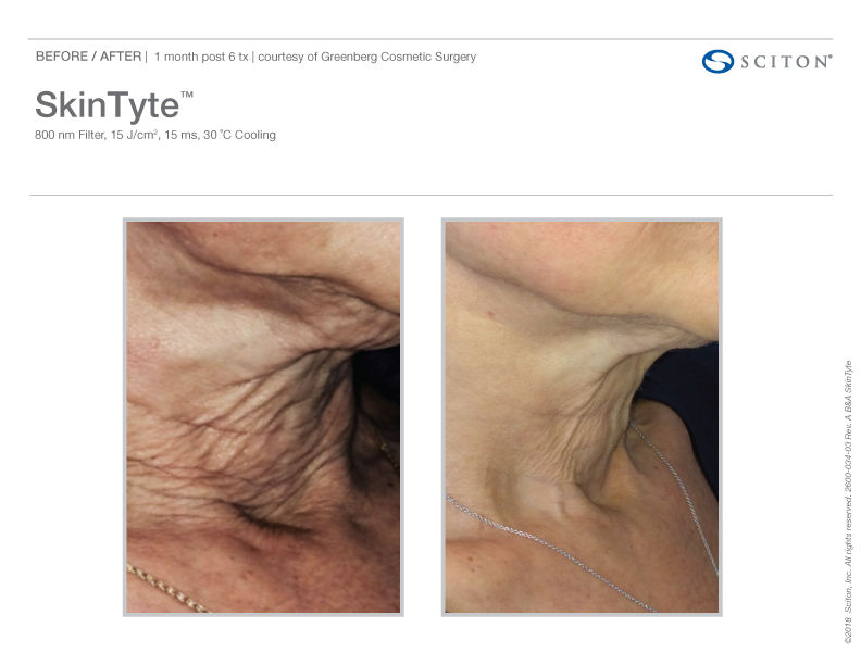 skin tyte laser results white female neck before and after treatment