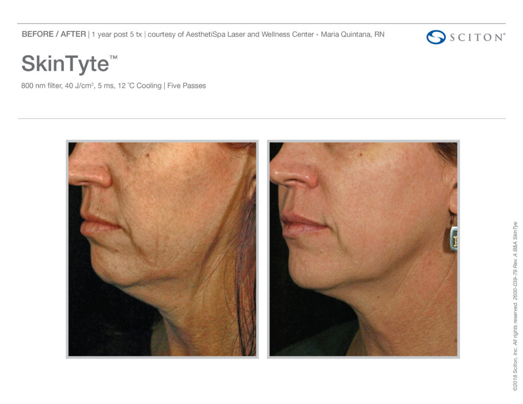 skin tyte laser results white female neck before and after treatment