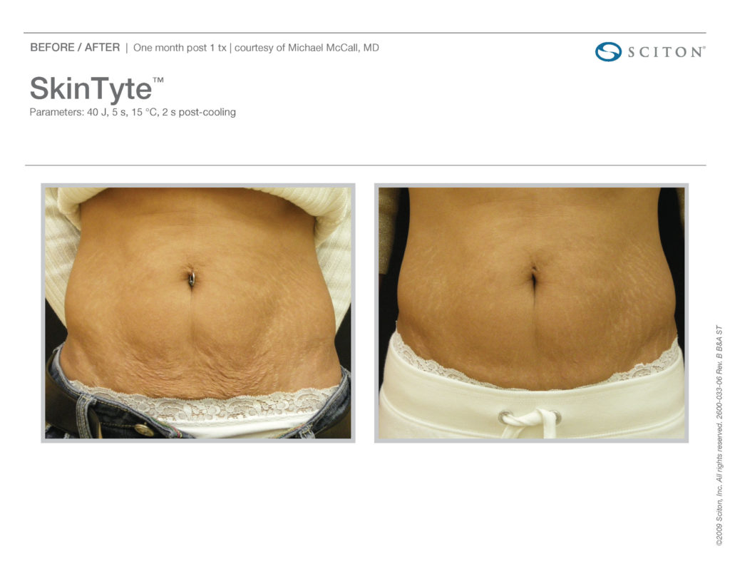 skin tyte laser results white female stomach before and after treatment