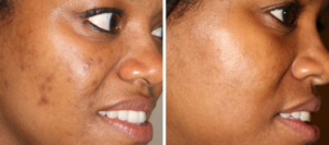 black female before and after superlative peel