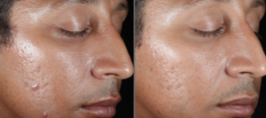 Asian male before and after vital peel facial